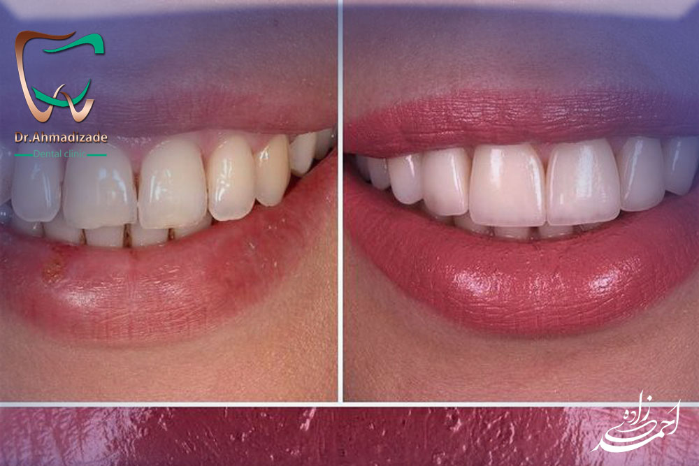 dental laminet 11