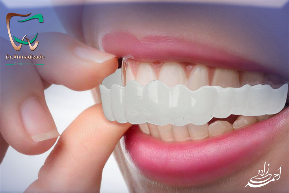 dental laminet 12