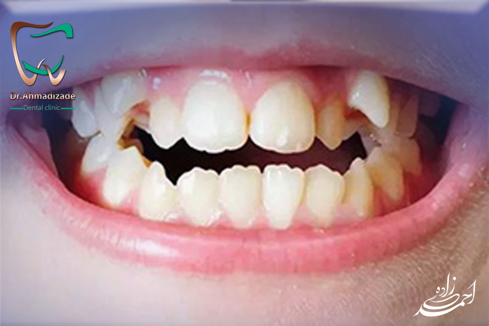 dental laminet 4