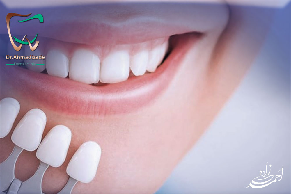 dental laminet 5