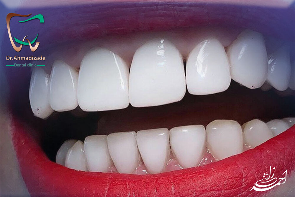 dental laminet 6