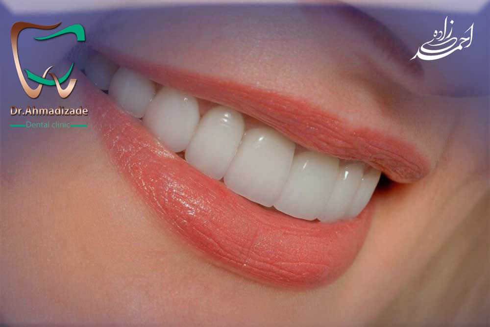 veneer1