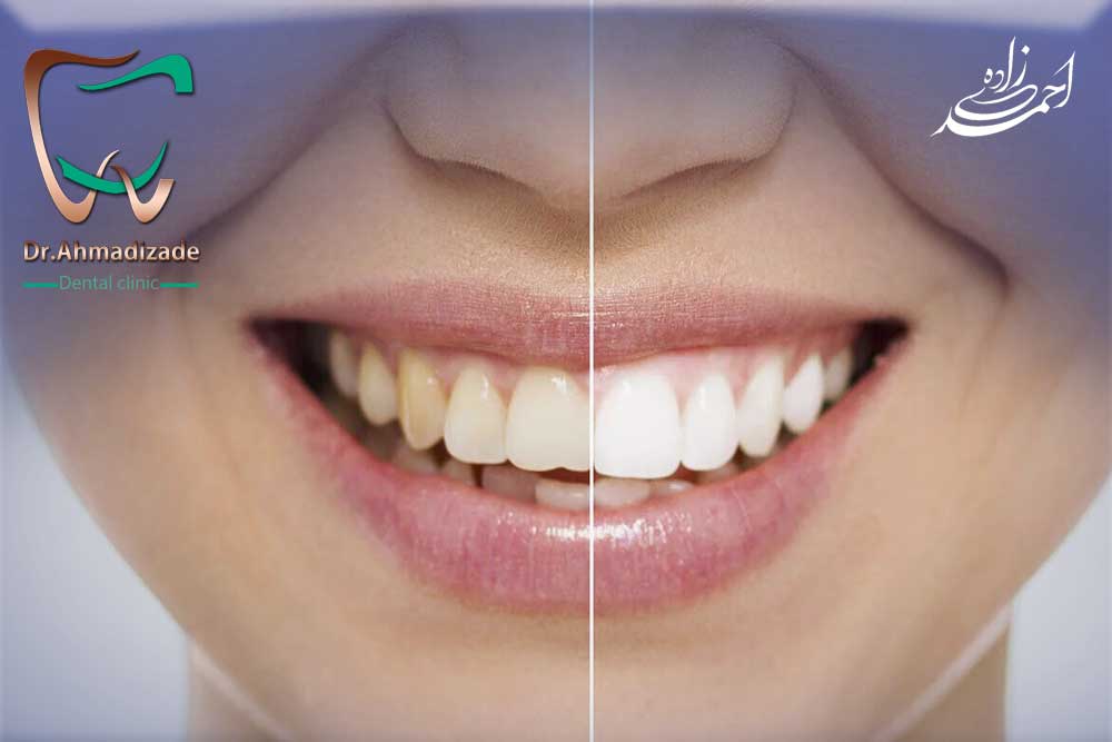 لمینت کردن دندان در قیطریه