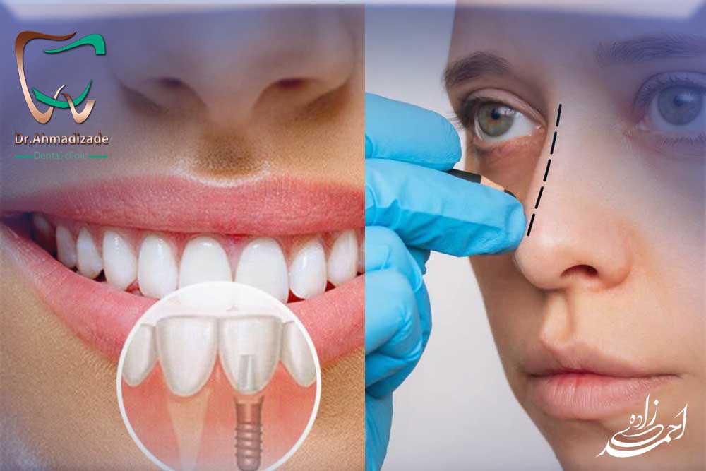 اول ایمپلنت کنیم یا جراحی بینی؟