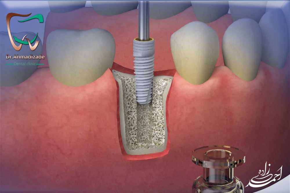 ایمپلنت دندان فوری یا ایمپلنت یک روزه
