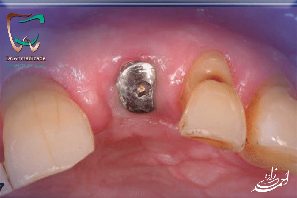 ایمپلنت دندان فوری یا ایمپلنت یک روزه