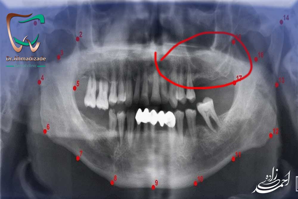 پیوند استخوان برای ایمپلنت دندان