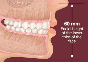 عوارض بی دندانی و ازدست دادن دندان