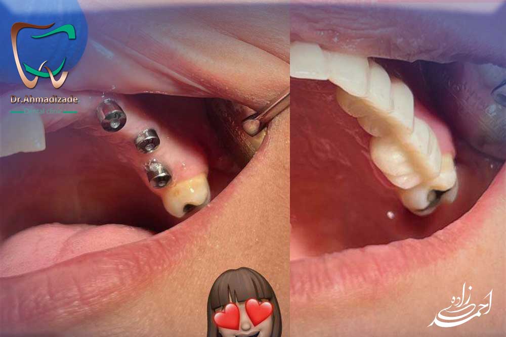 مزایای ایمپلنت افزایش اعتماد به نفس