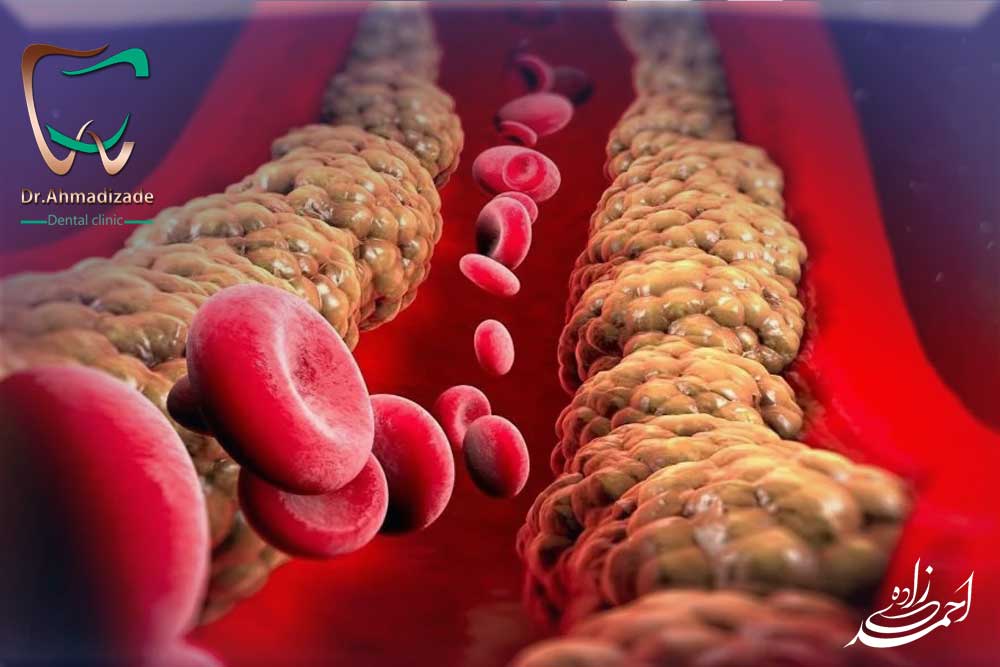 قبل از انجام جراحی ایمپلنت و سینوس لیفت