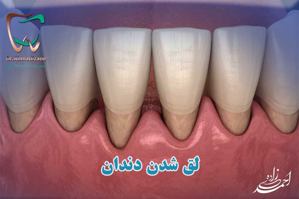 لق شدن دندان