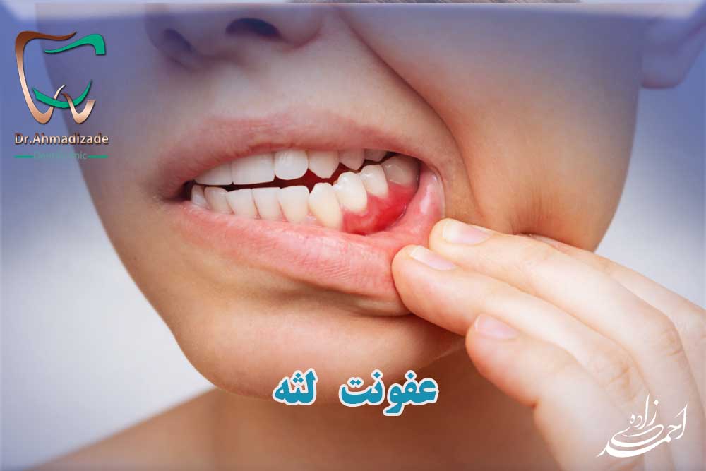 عفونت لثه ها
