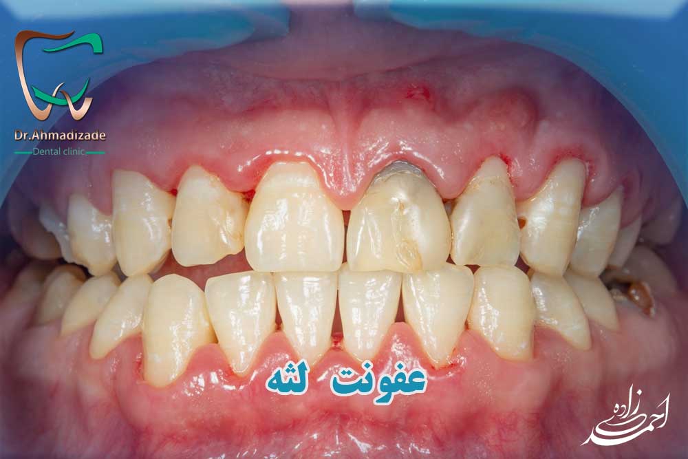 عفونت لثه