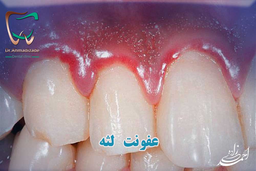 عفونت لثه و دهان و دندان
