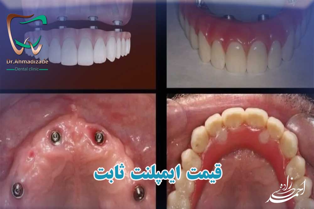قیمت ایمپلنت ثابت