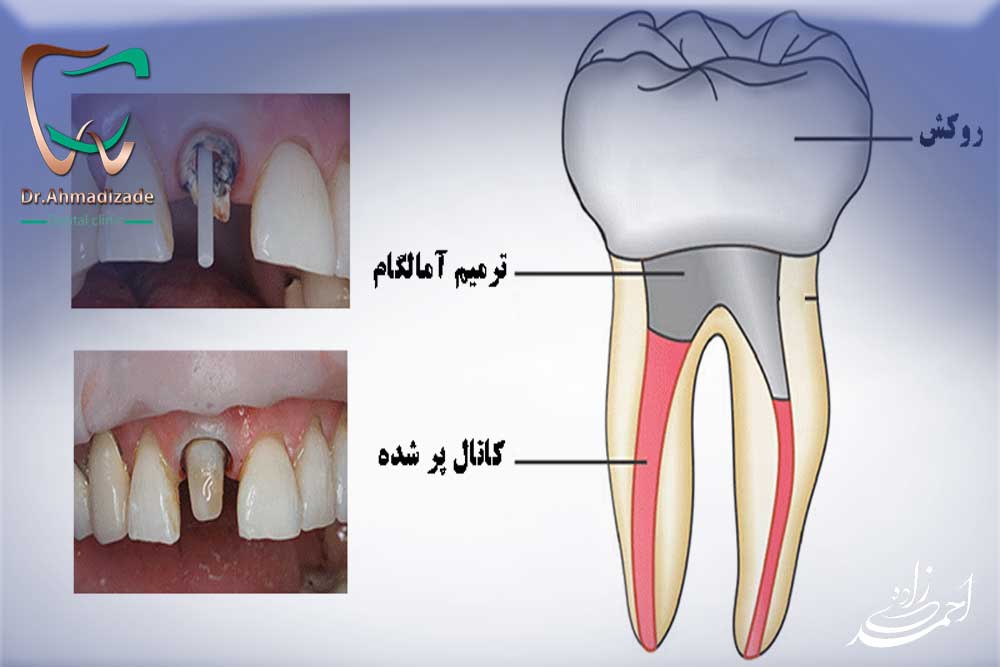 ترمیم دندان با روکش