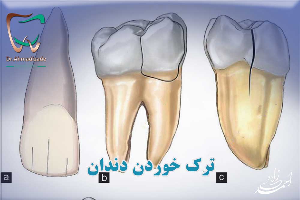 Cracked Tooth2
