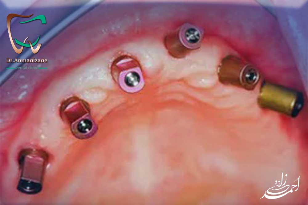 faq implant 3