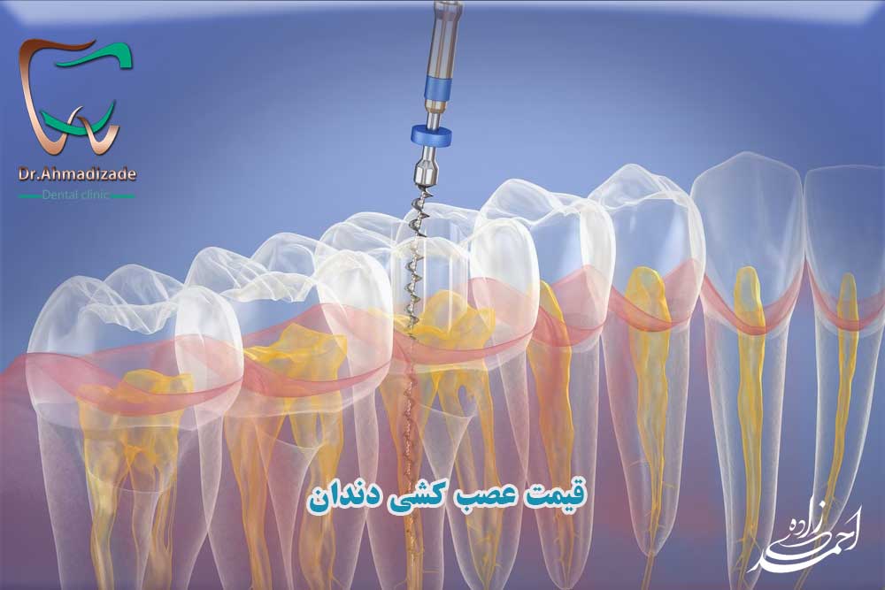 قیمت عصب کشی دندان 6