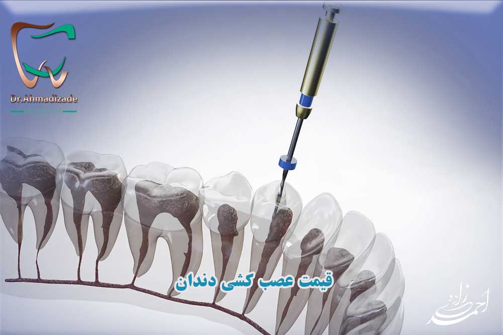 قیمت عصب کشی دندان در تهران