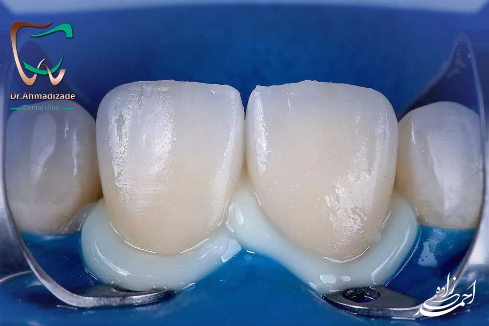 sen veneer1