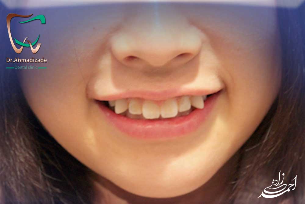 sen veneer2