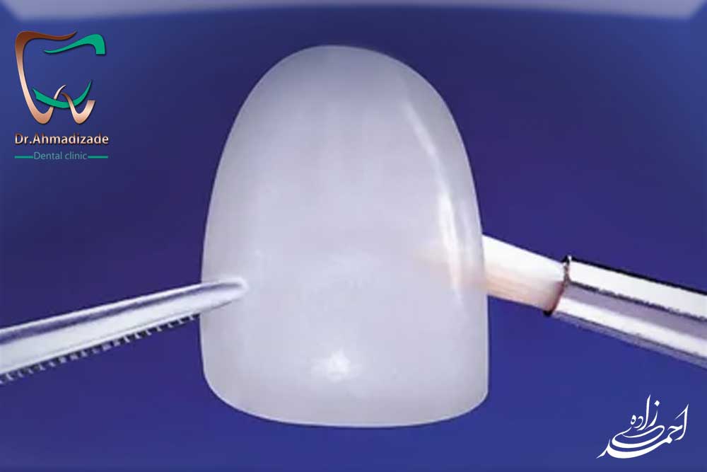 sen veneer4