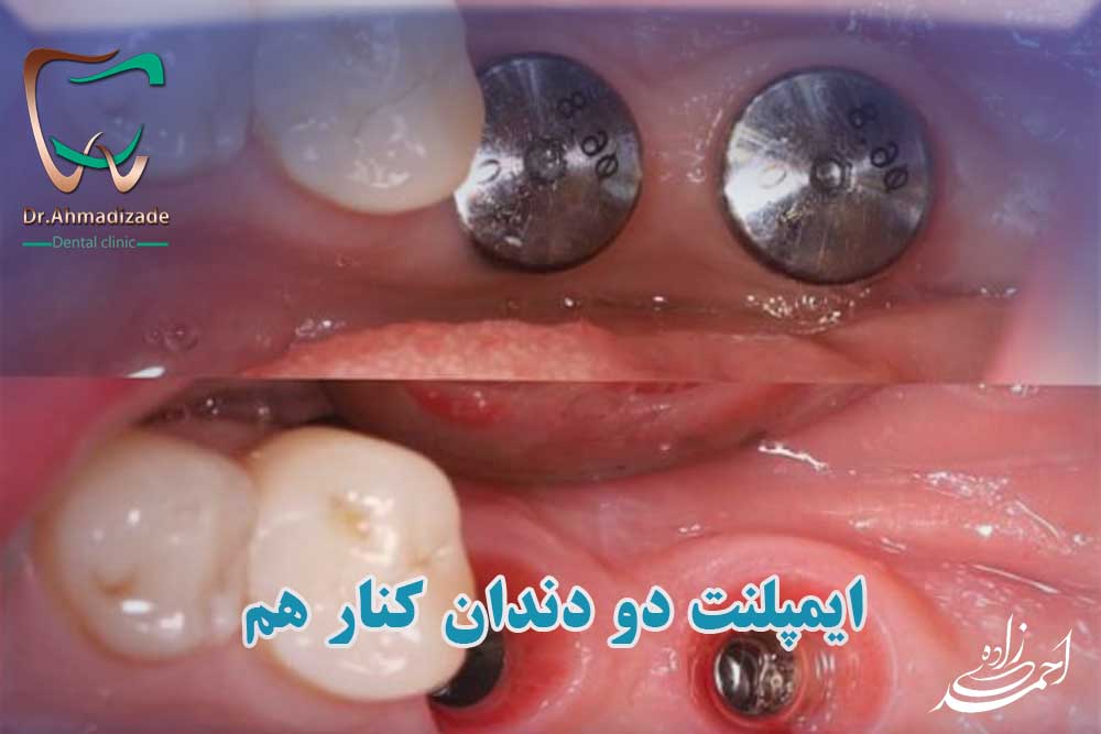 ایمپلنت دو دندان کنارهم چگونه انجام می شود