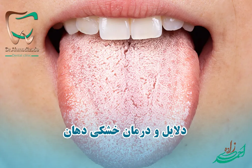 خشکی دهان یا زروستومیا چیست؟ علت علائم و درمان