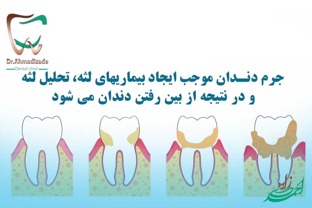جرم گیری دندان را خراب میکند؟