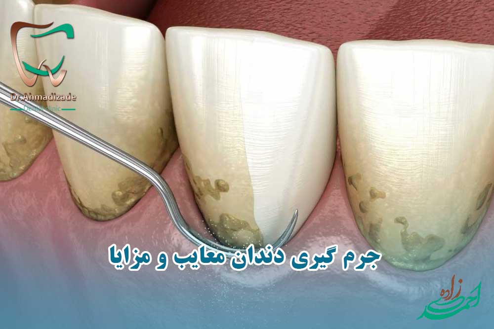 جرم گیری دندان را خراب میکند؟