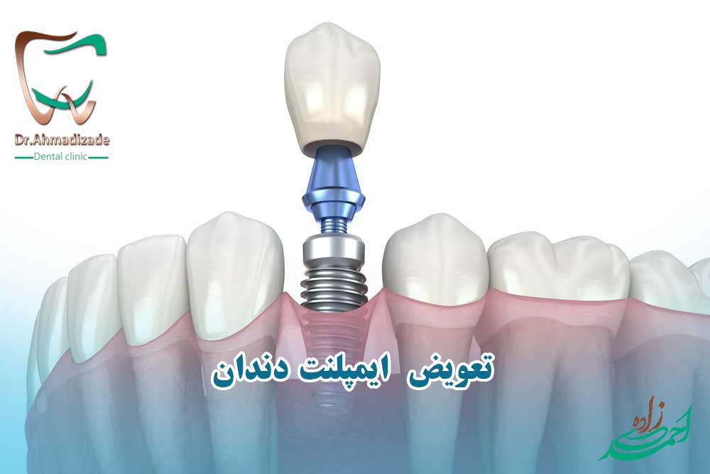 تعویض ایمپلنت دندان